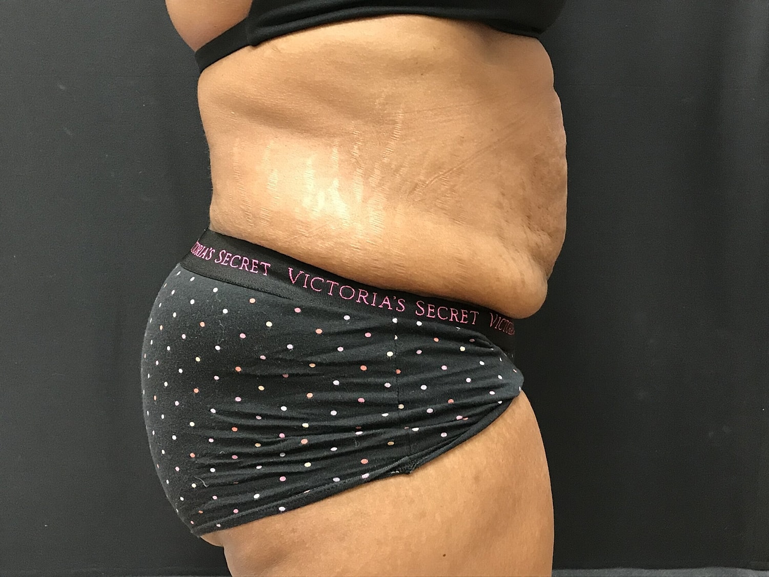 Tummy Tuck Before & After