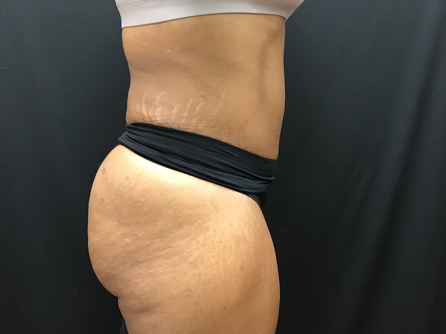 Tummy Tuck Before & After
