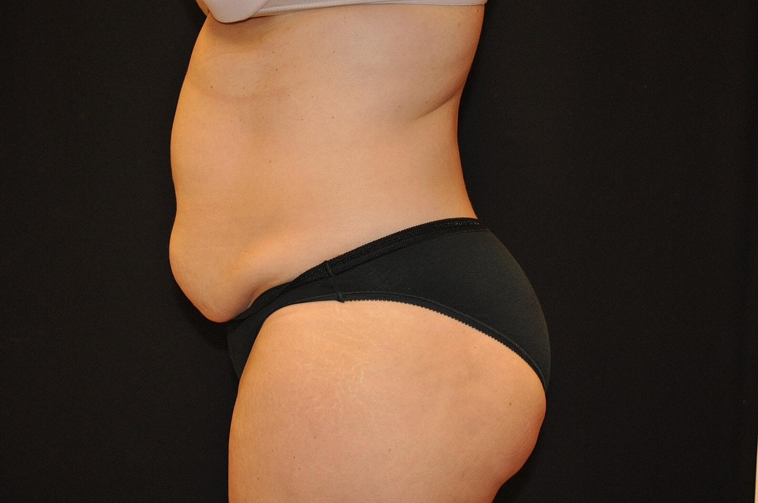 Tummy Tuck Before & After