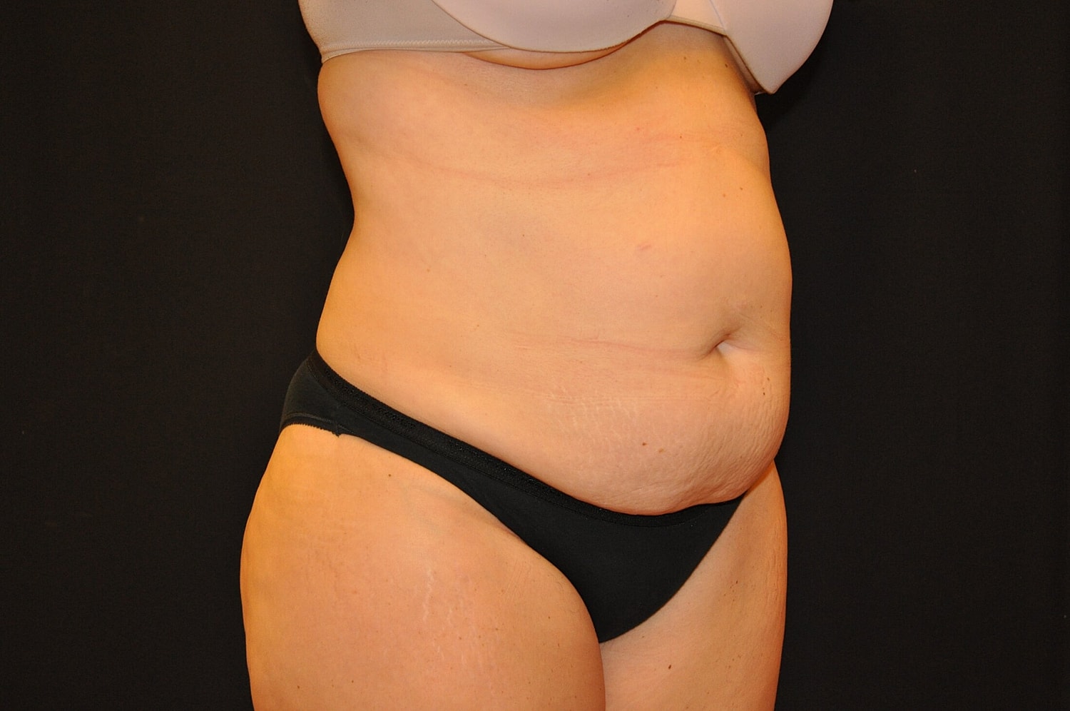Tummy Tuck Before & After