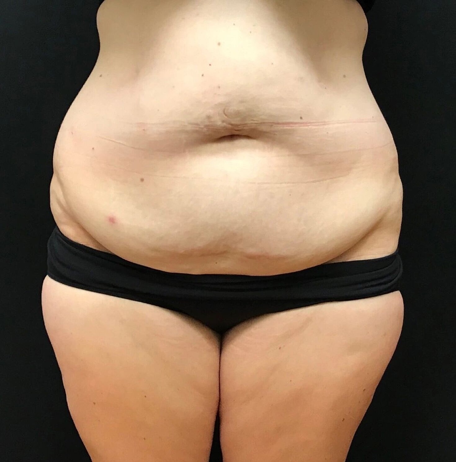 Tummy Tuck Before & After