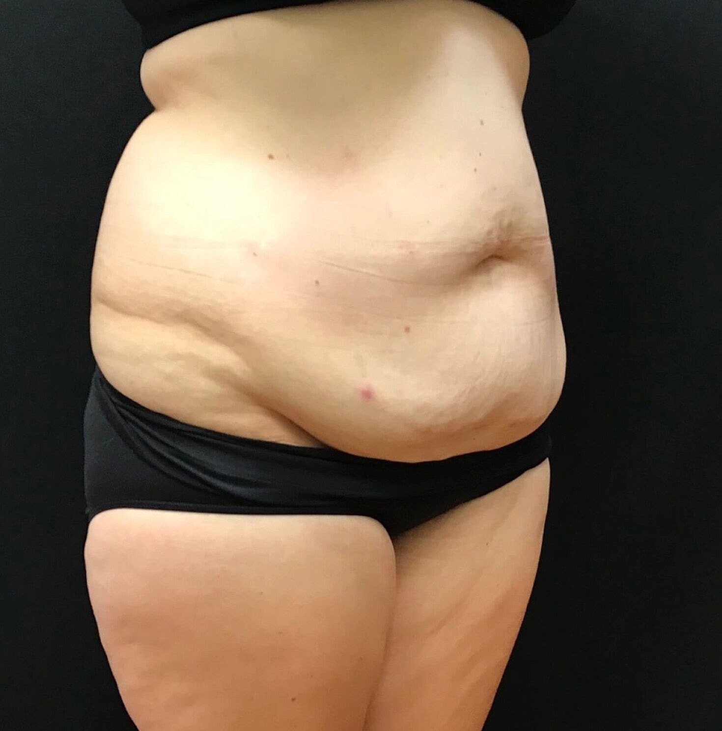 Tummy Tuck Before & After