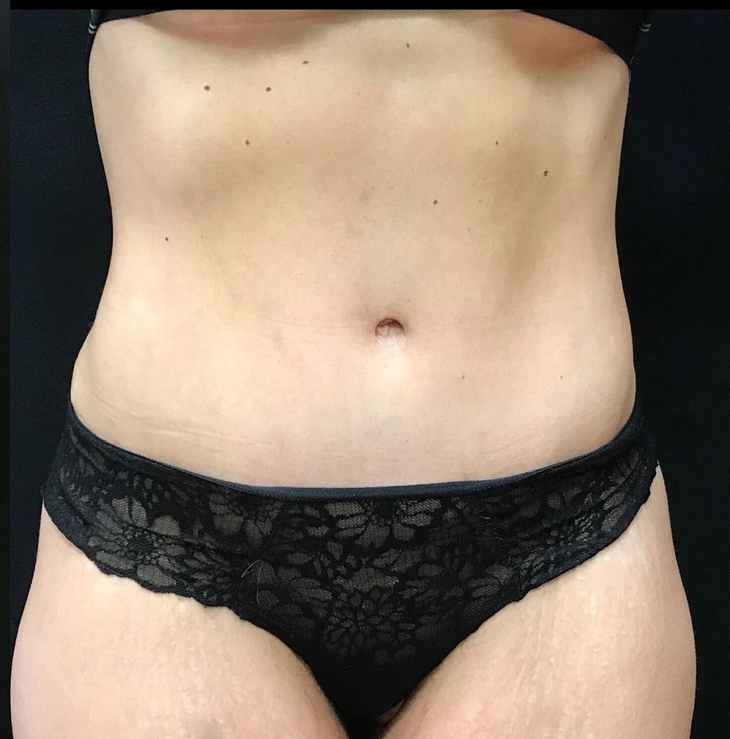 Tummy Tuck Before & After