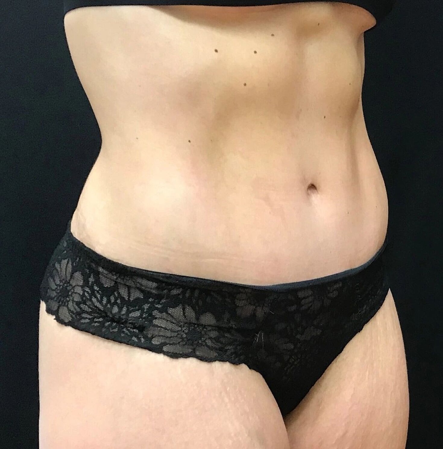 Tummy Tuck Before & After