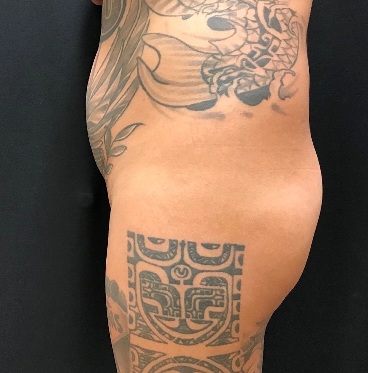 Butt Implants Before & After