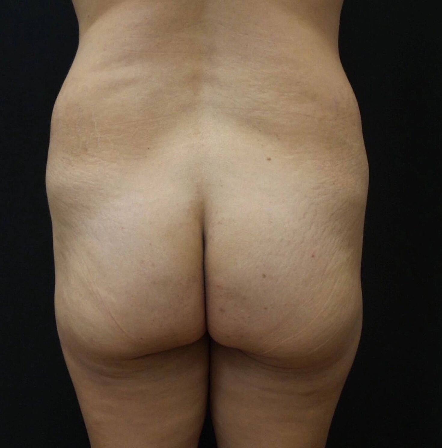 Butt Implants Before & After