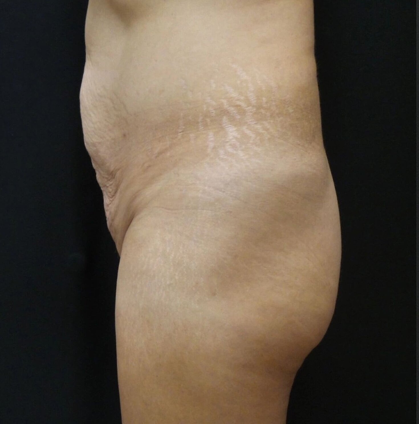 Butt Implants Before & After