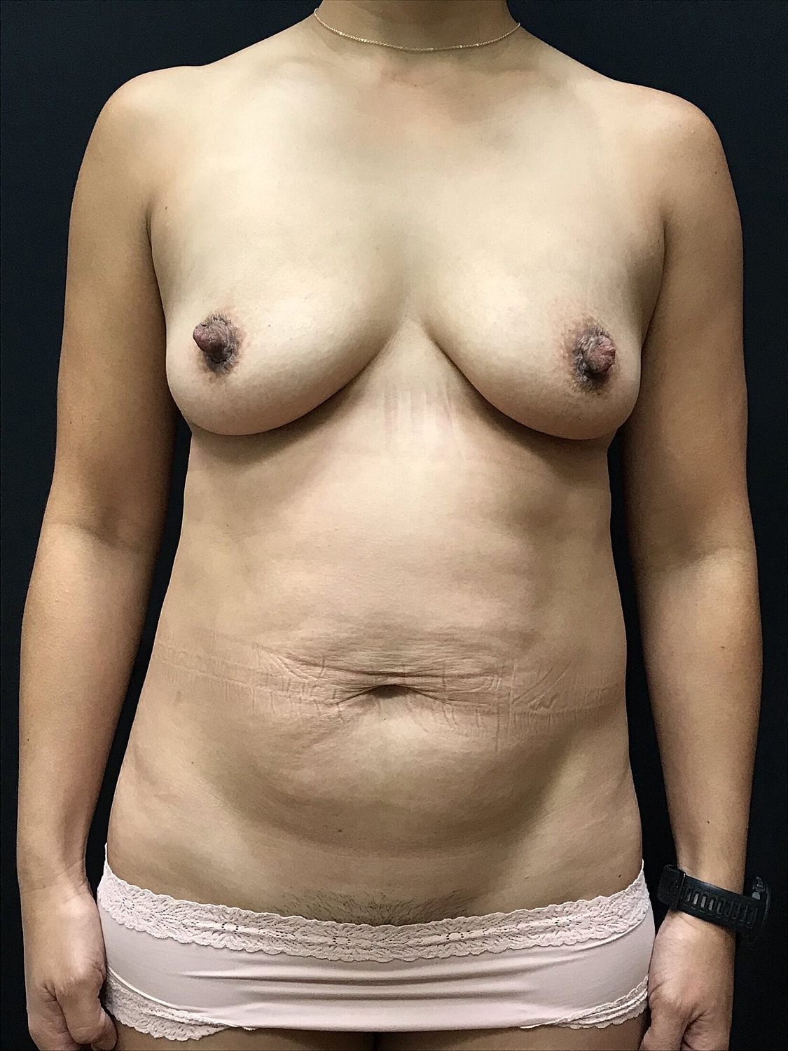 Mommy Makeover Before & After