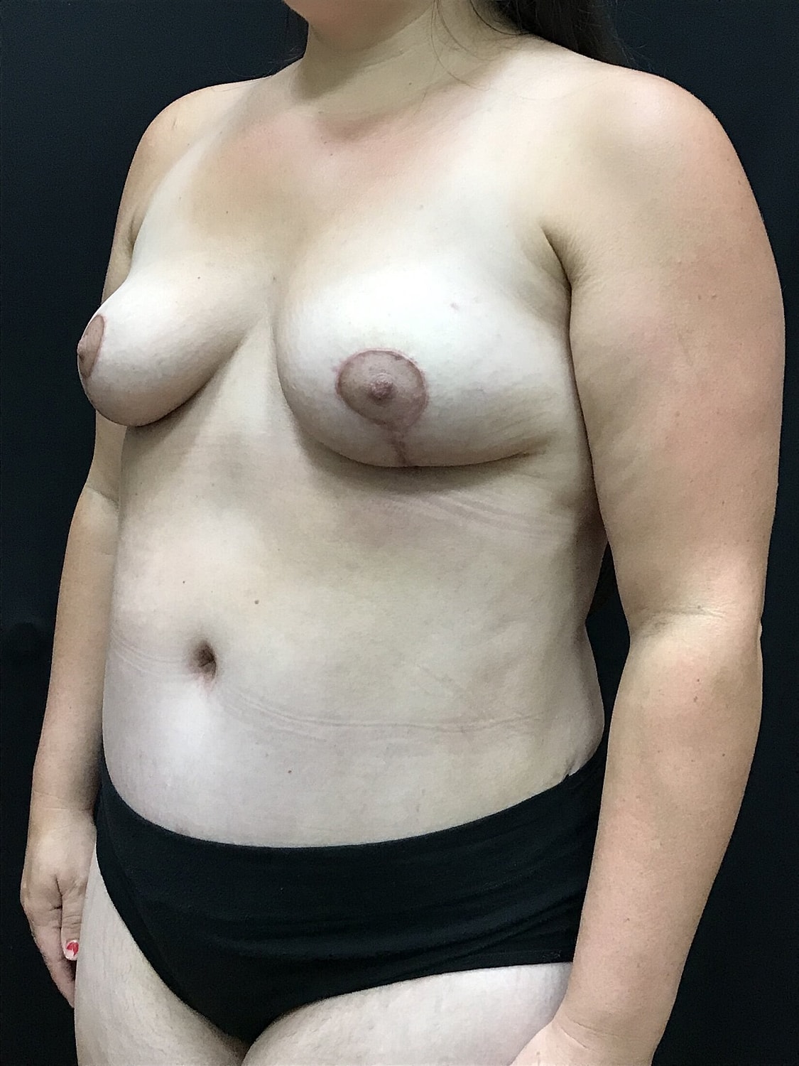 Mommy Makeover Before & After