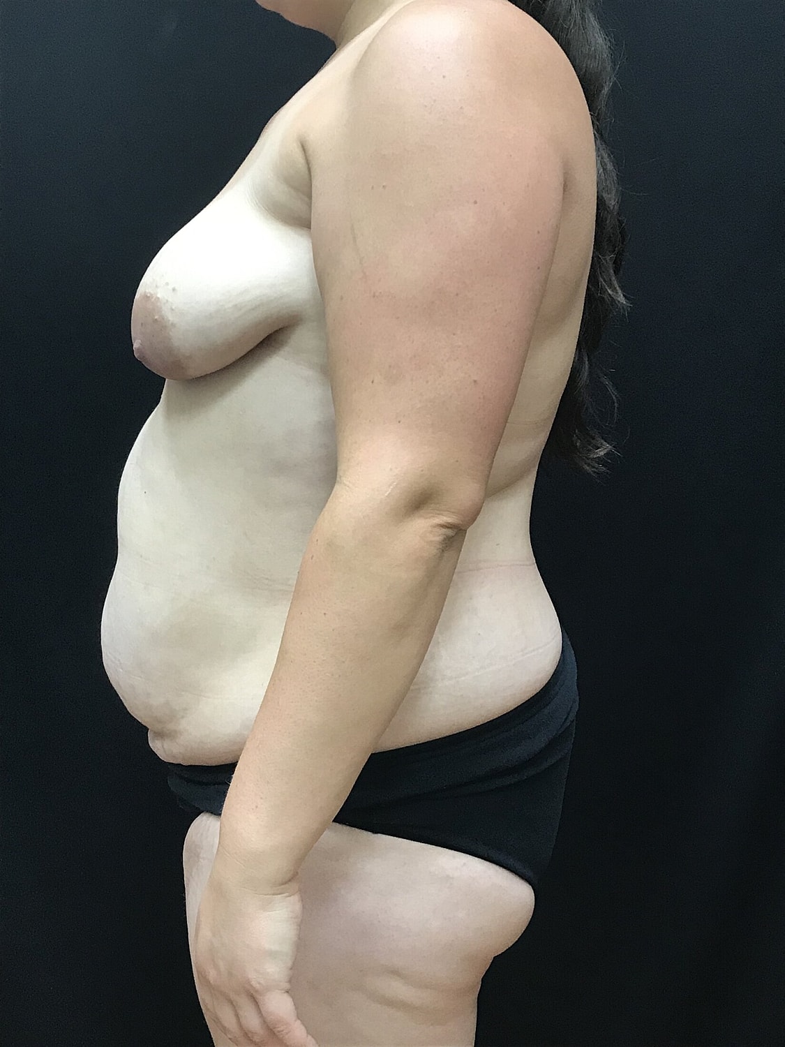 Mommy Makeover Before & After