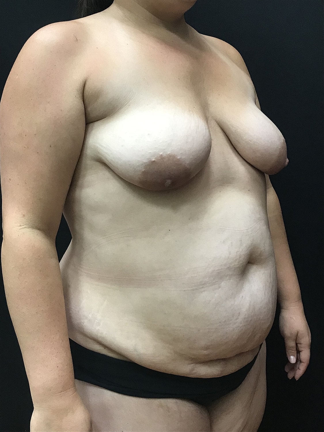 Mommy Makeover Before & After