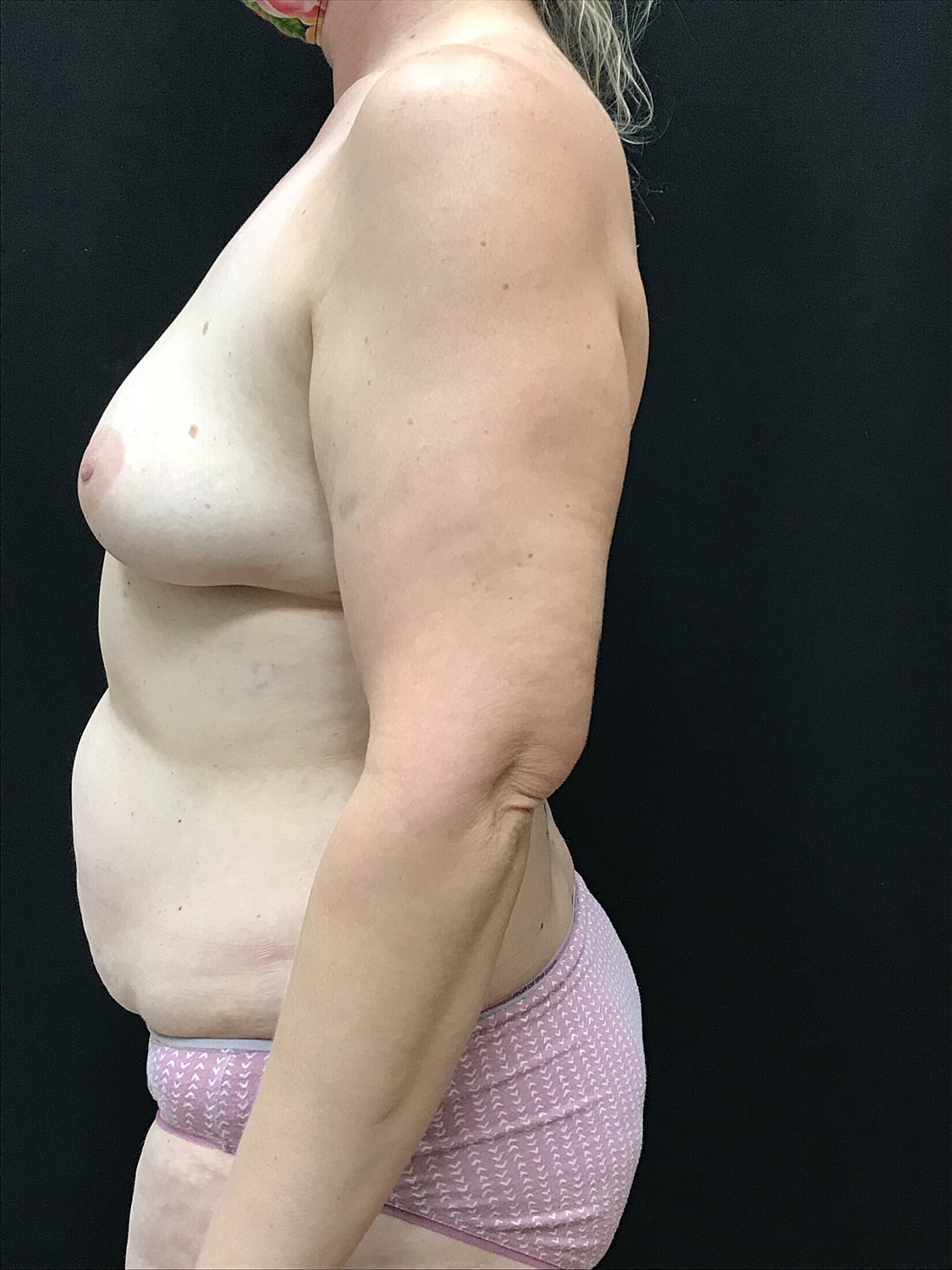 Mommy Makeover Before & After