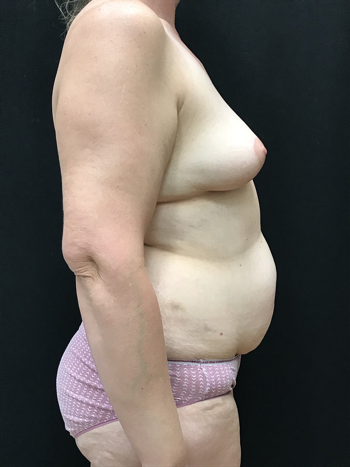 Mommy Makeover Before & After