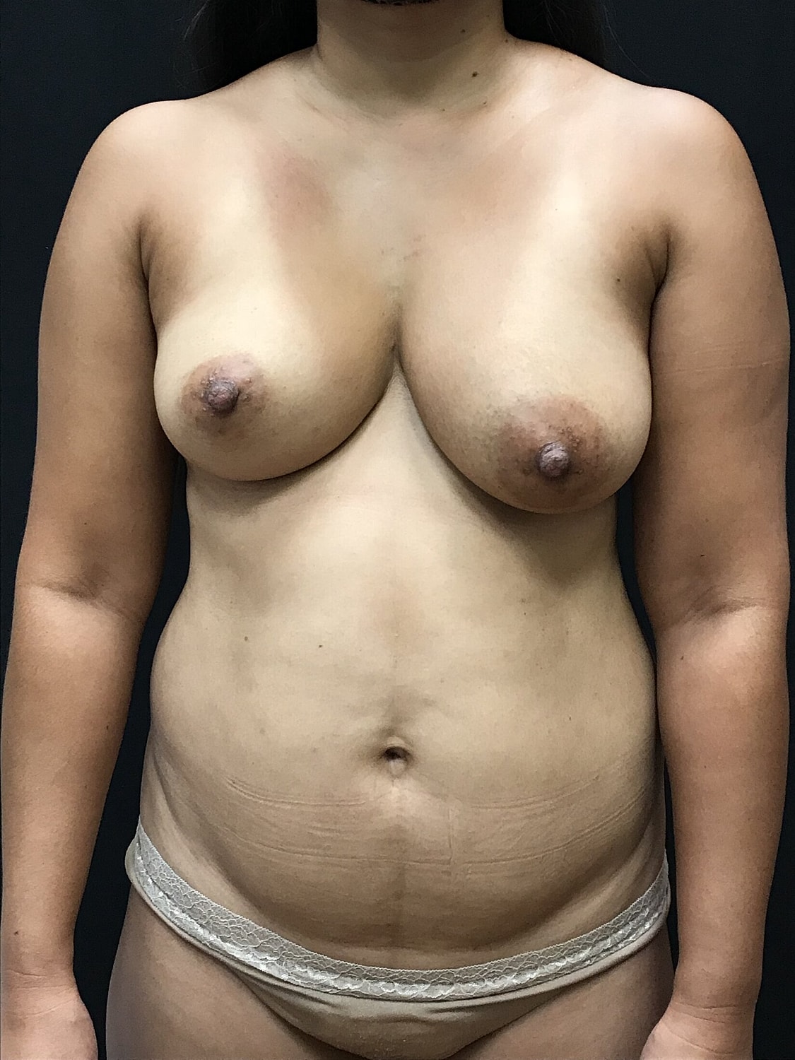 Mommy Makeover Before & After