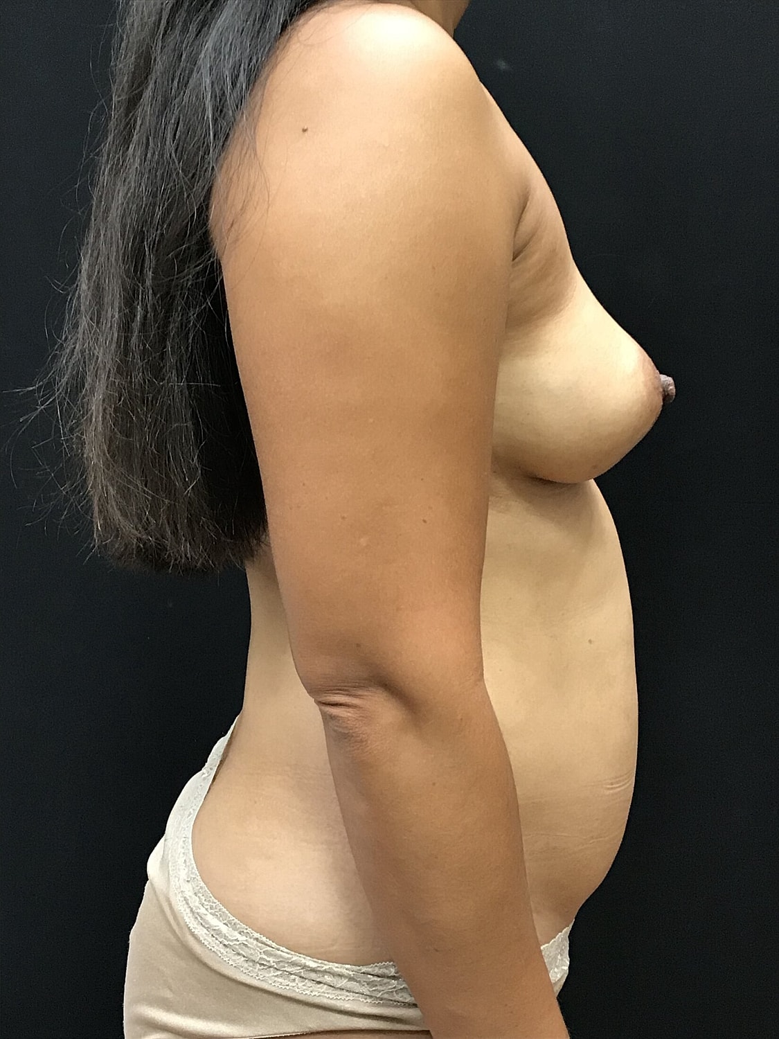 Mommy Makeover Before & After