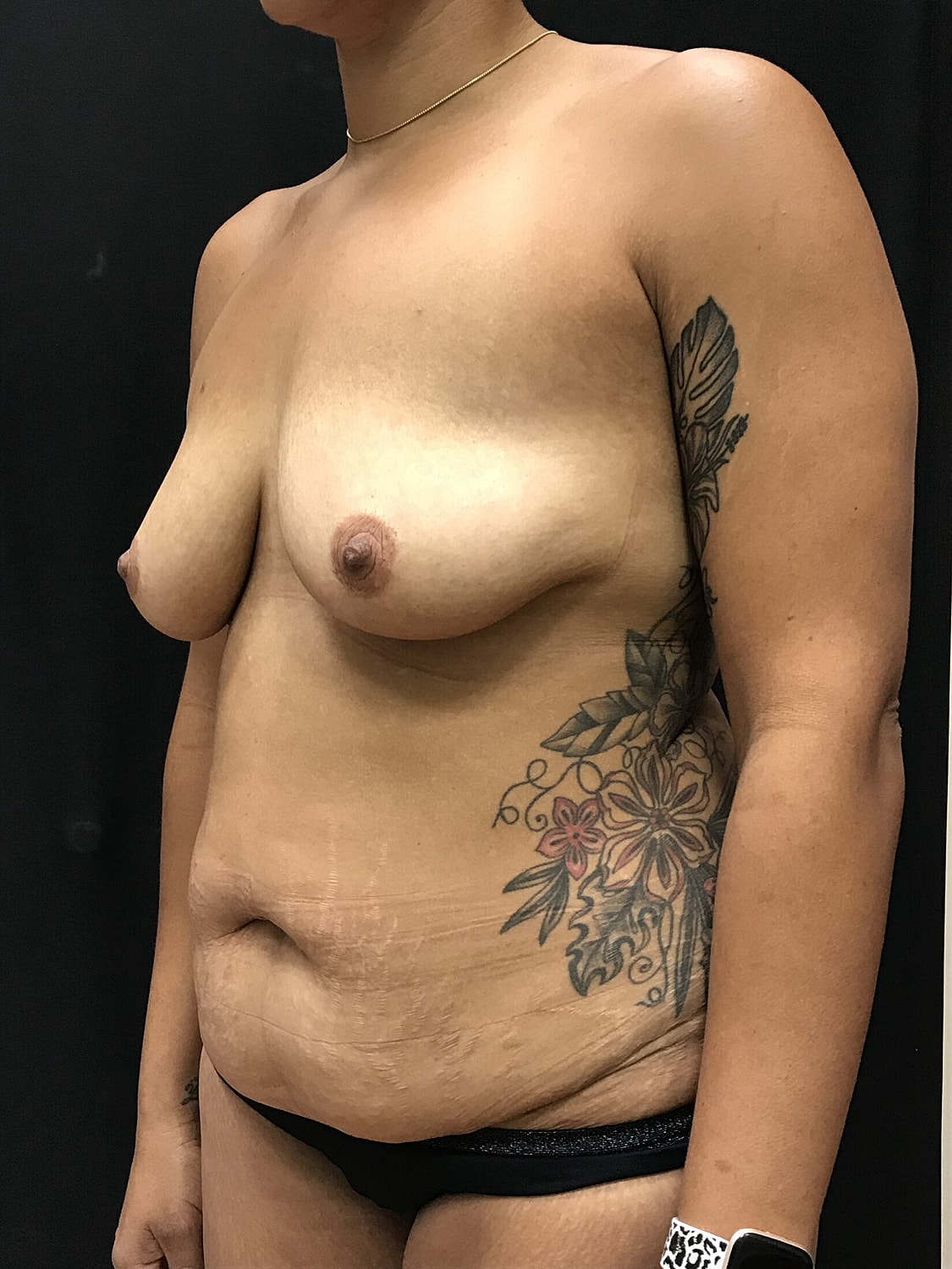 Mommy Makeover Before & After