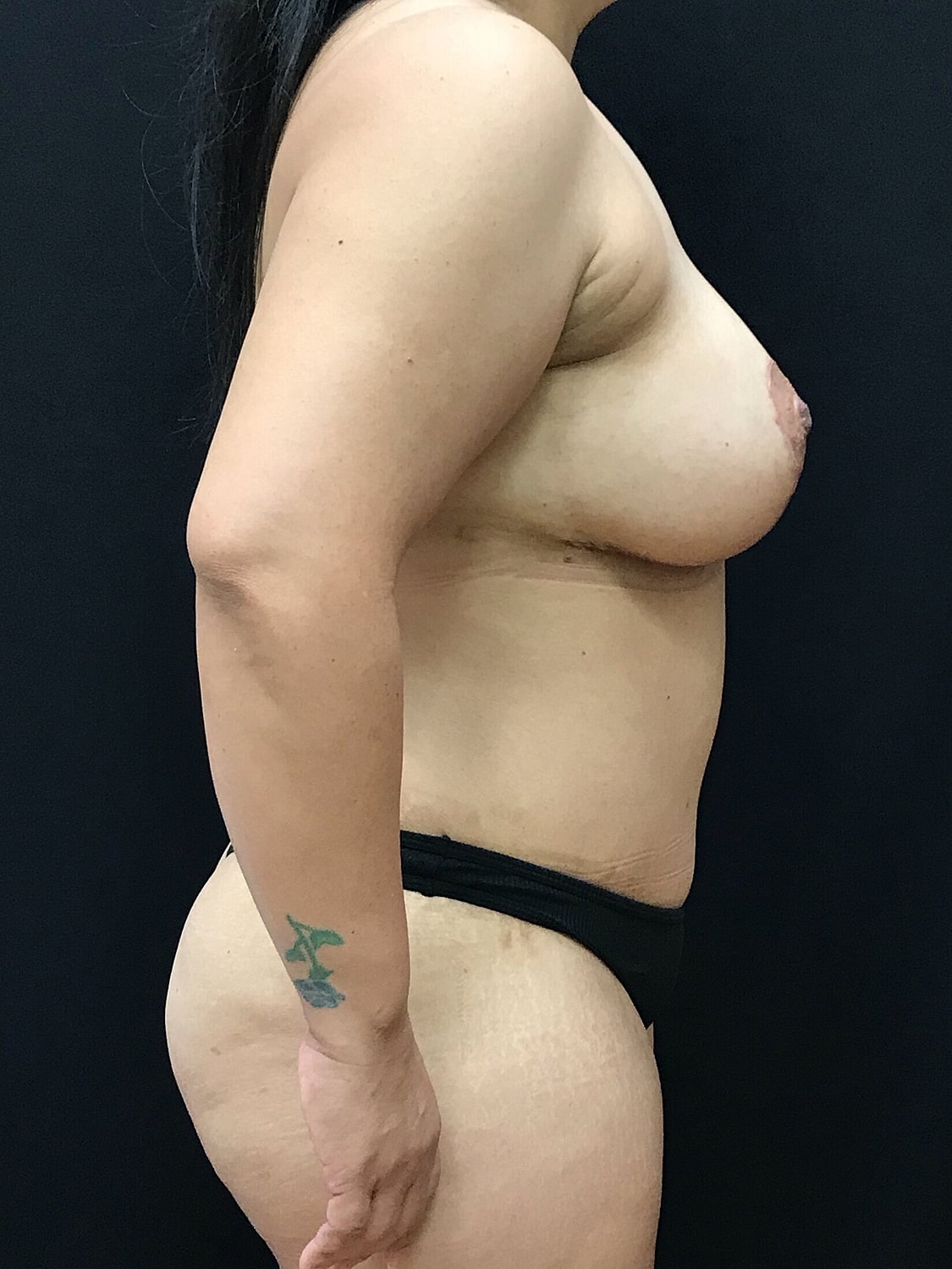 Mommy Makeover Before & After