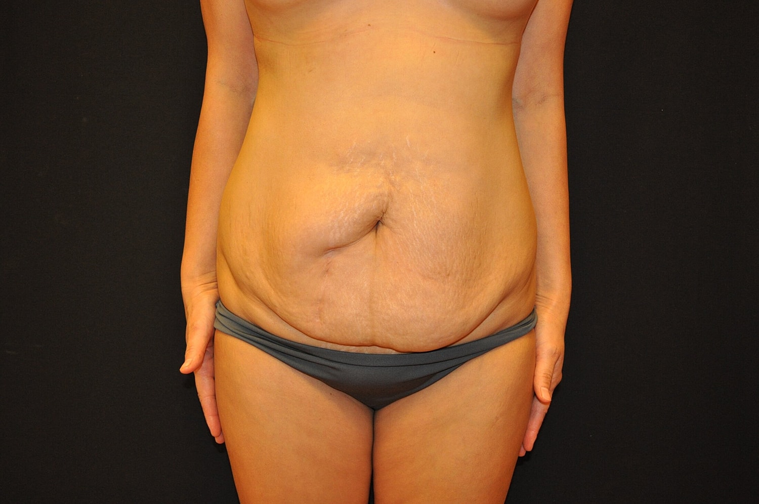 Mommy Makeover Before & After