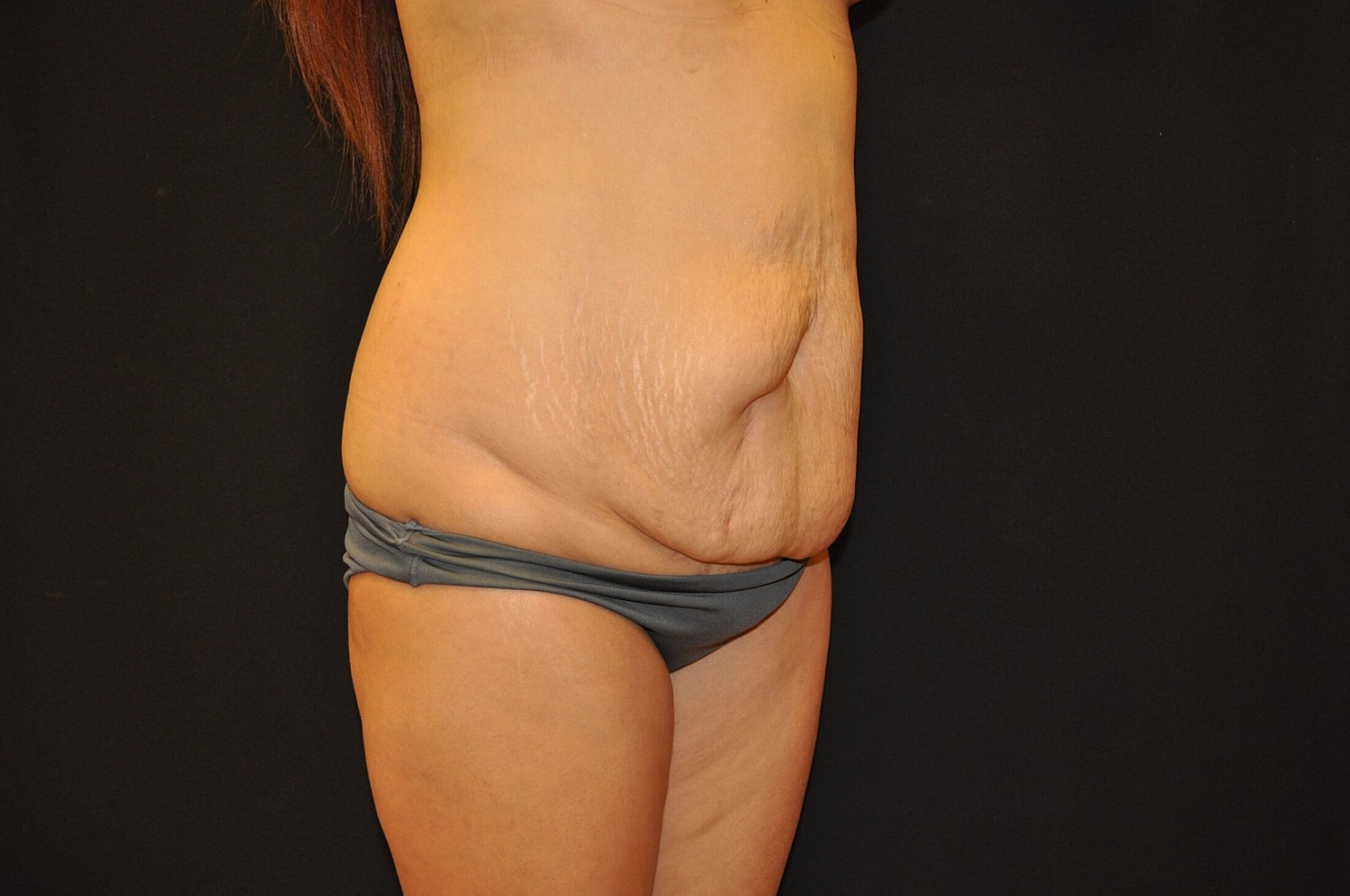 Mommy Makeover Before & After