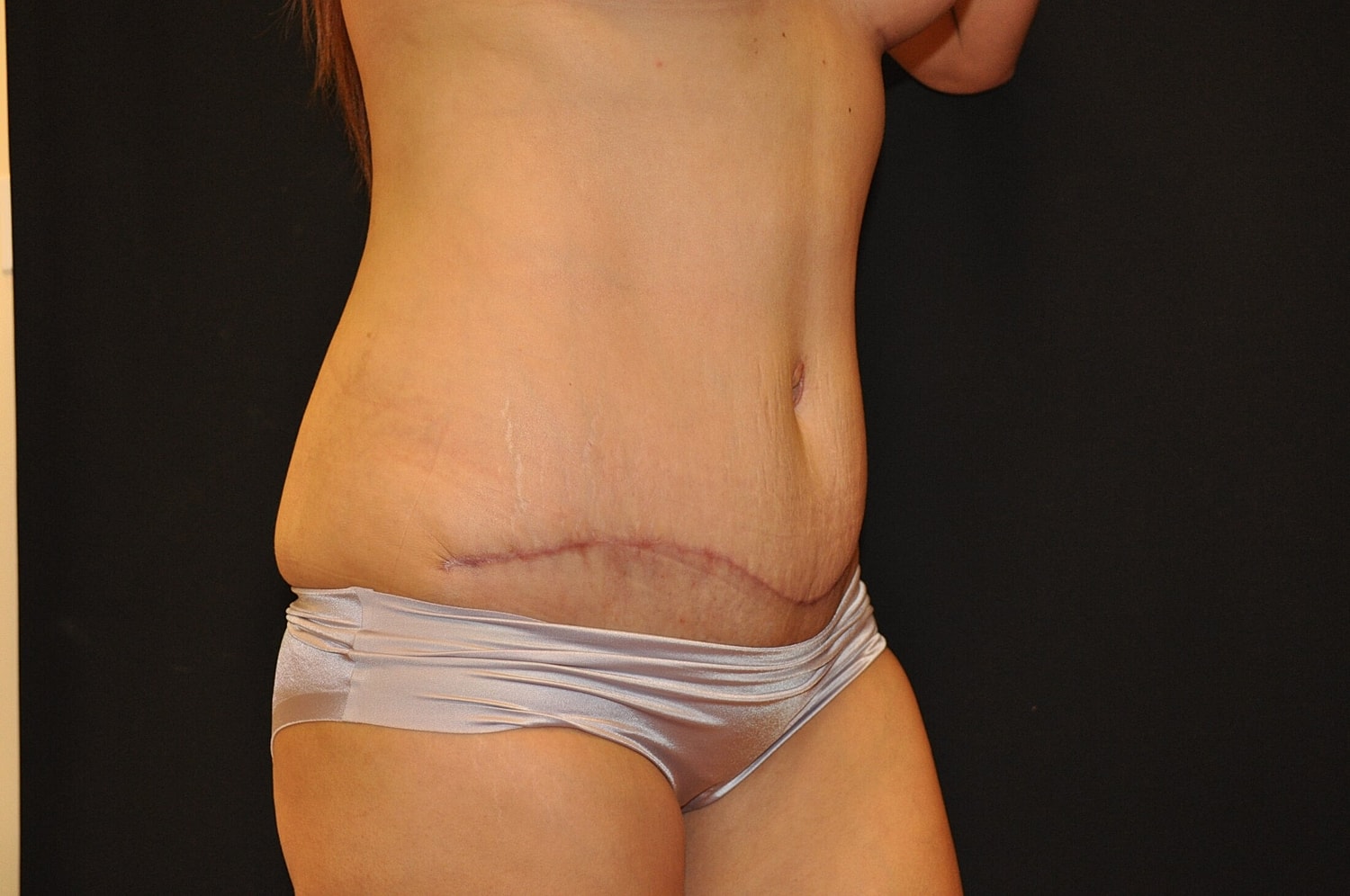 Mommy Makeover Before & After