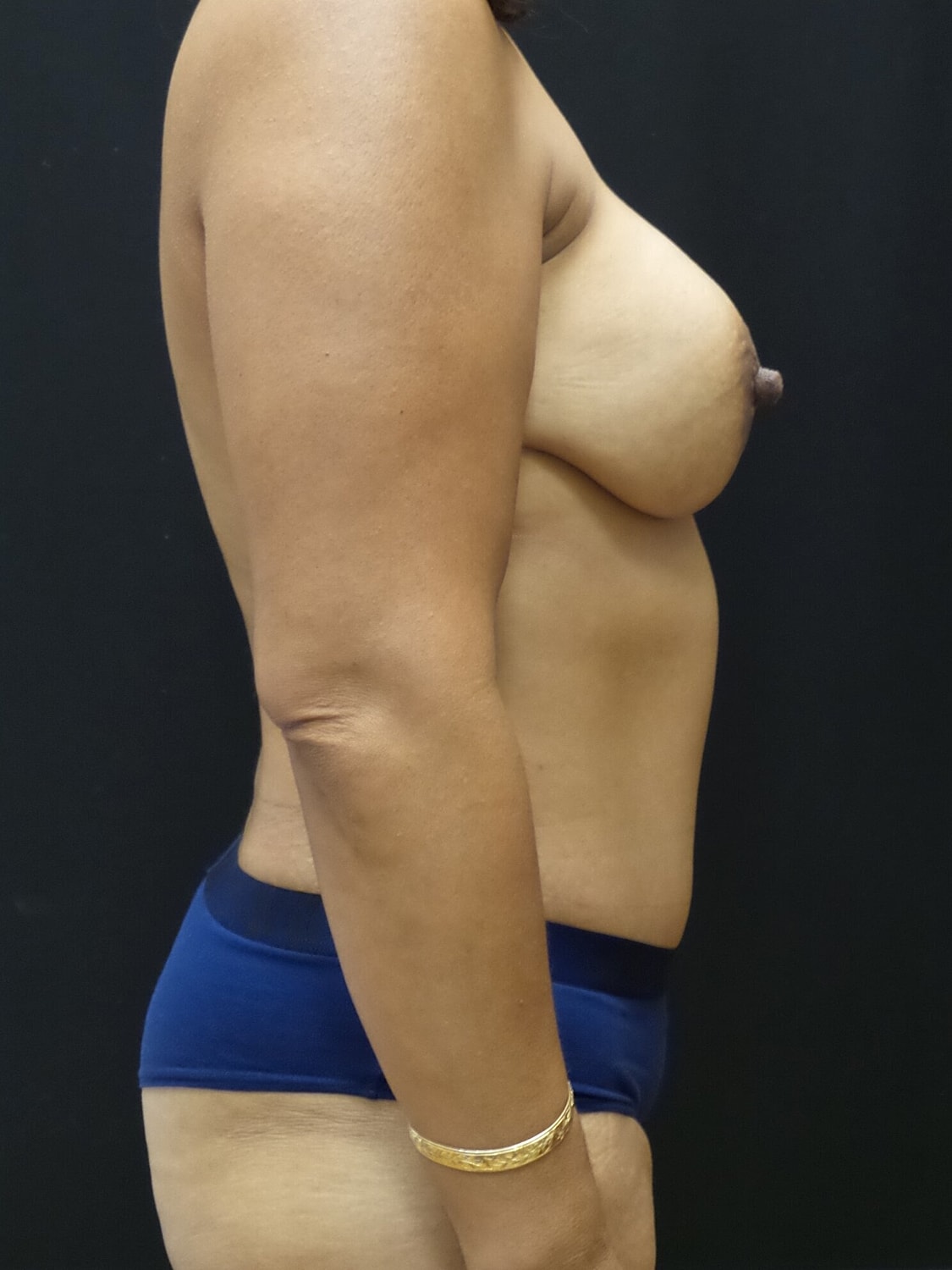 Mommy Makeover Before & After