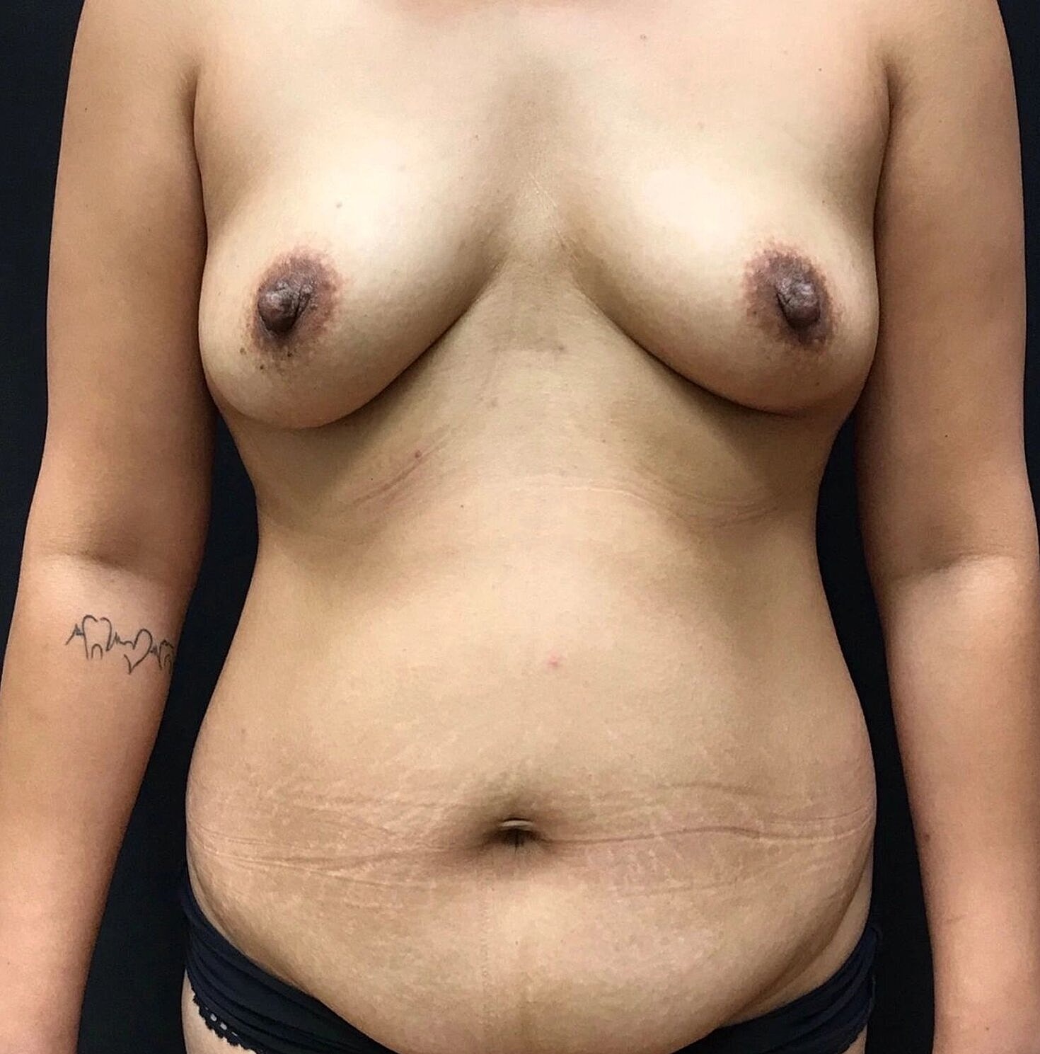 Mommy Makeover Before & After