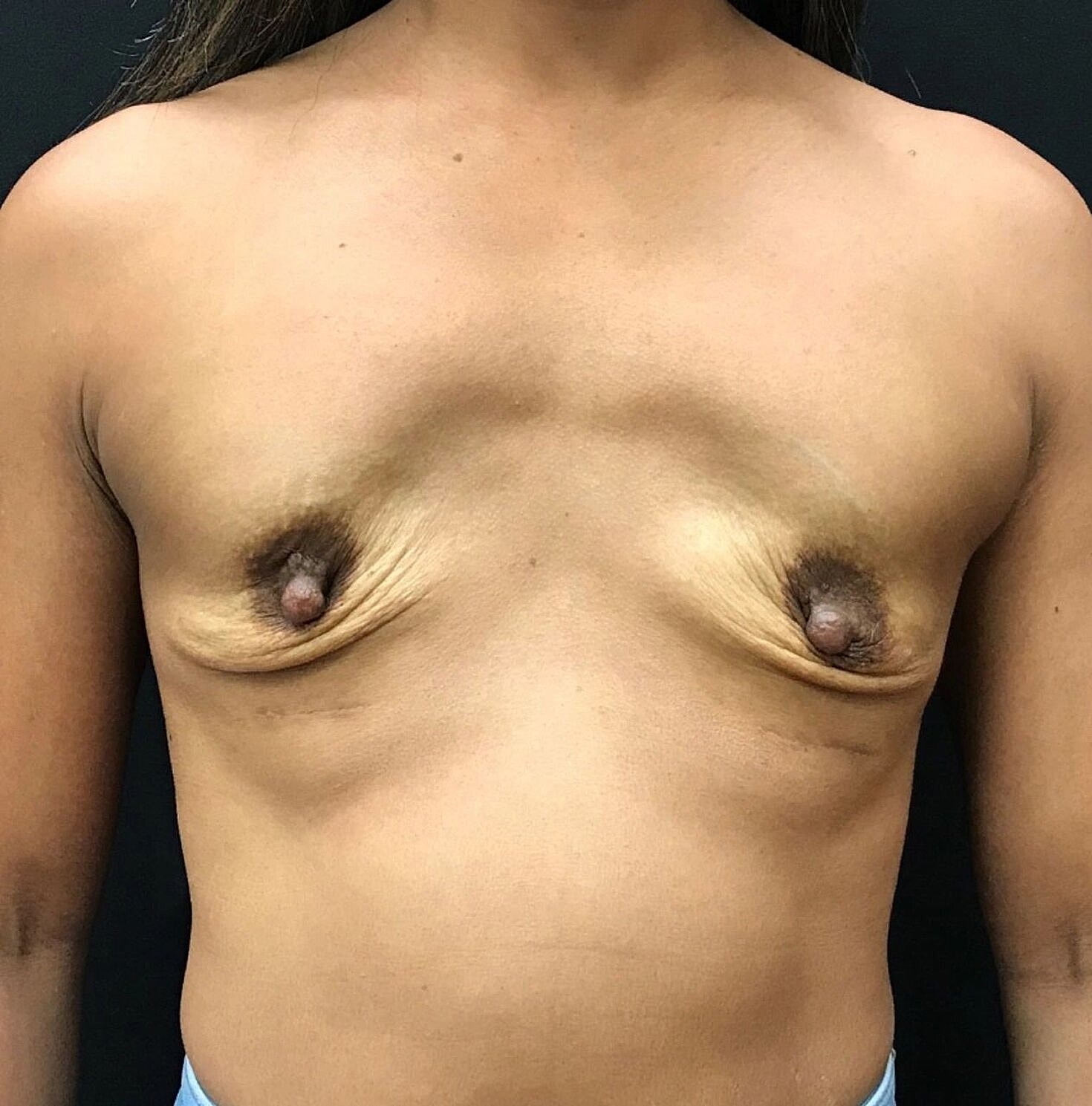 Breast Revision Before & After