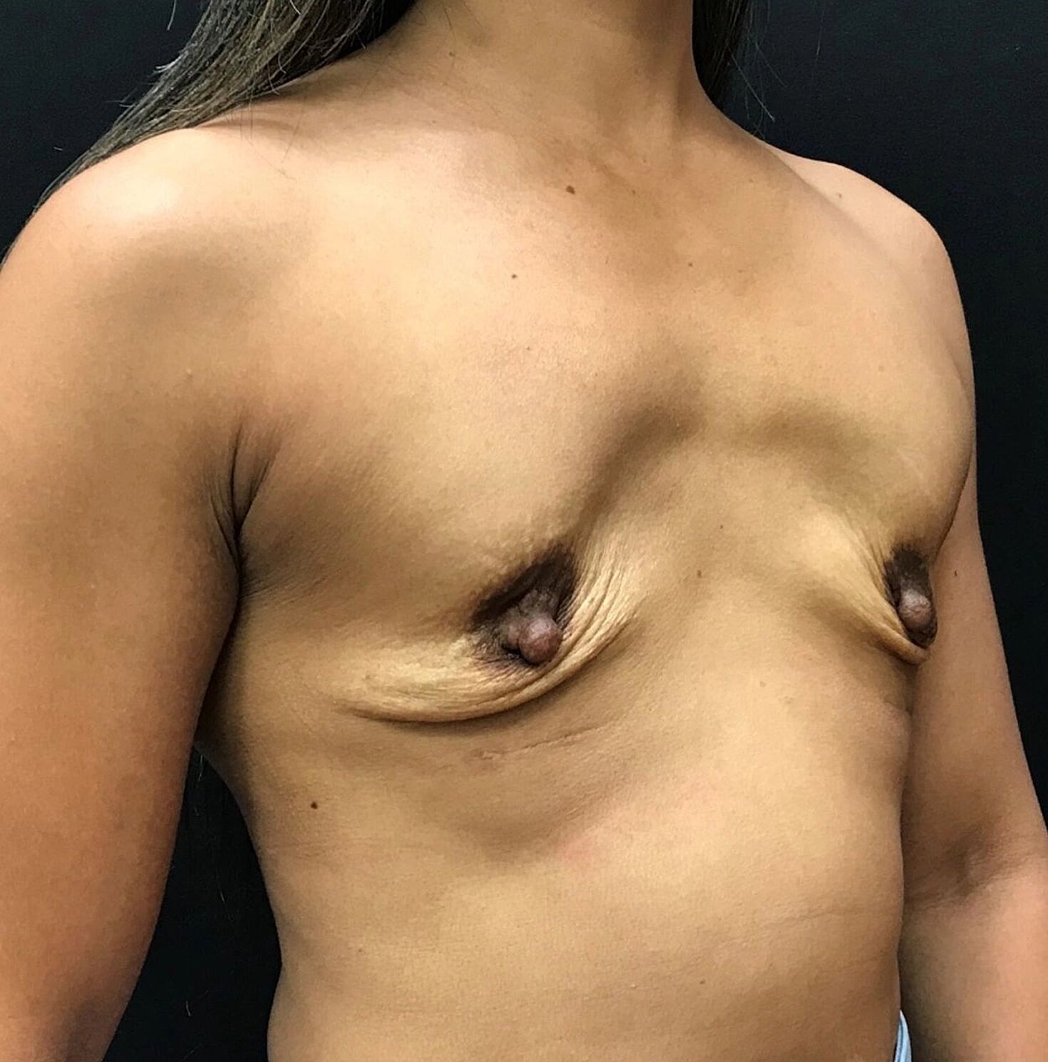 Breast Revision Before & After