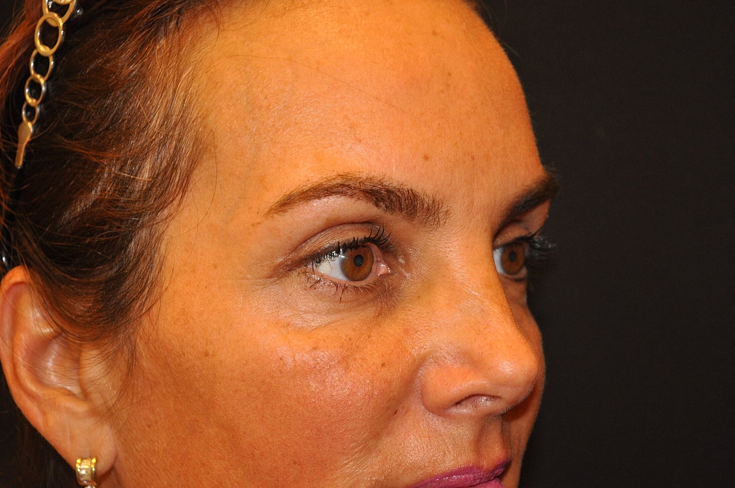 Blephroplasty Before & After