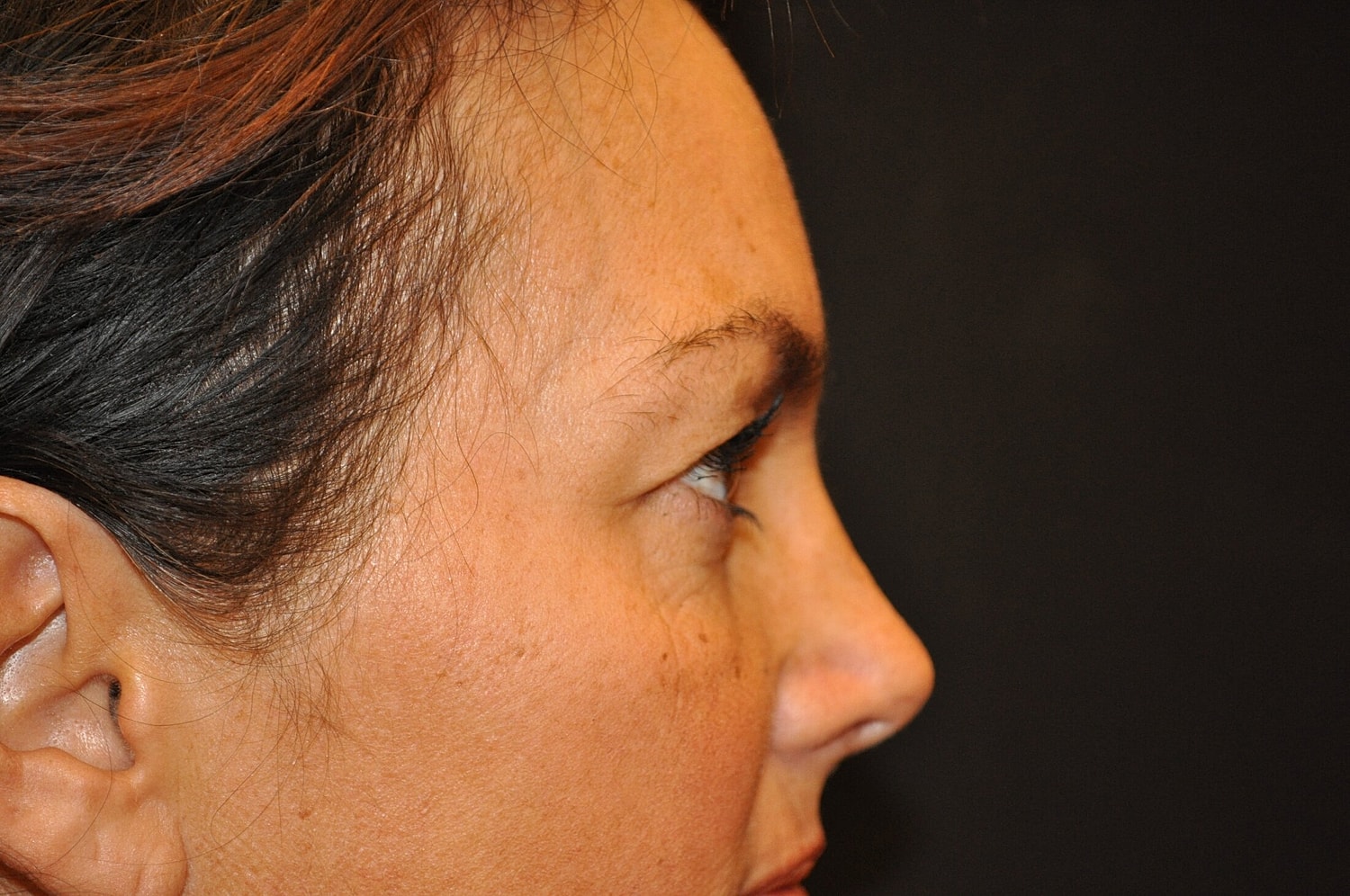 Blephroplasty Before & After