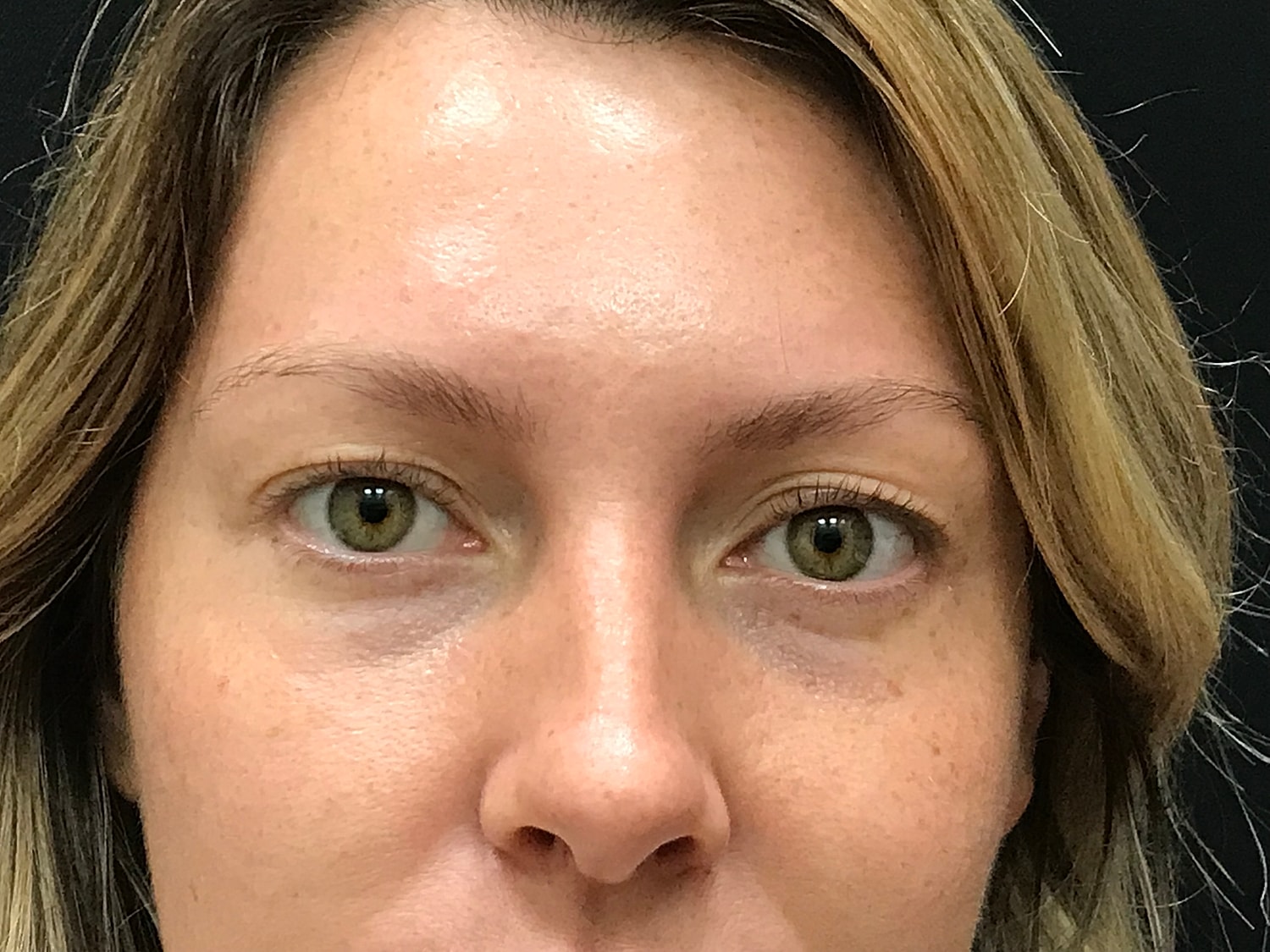 Blephroplasty [.block]Gallery[] Before & After