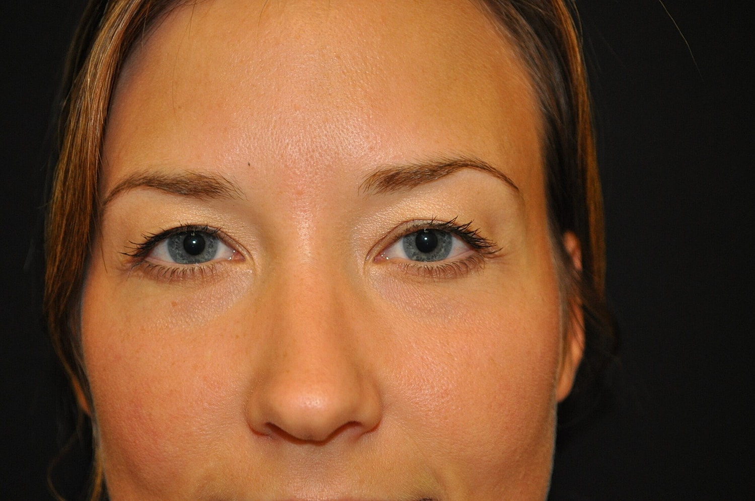 Blephroplasty Before & After