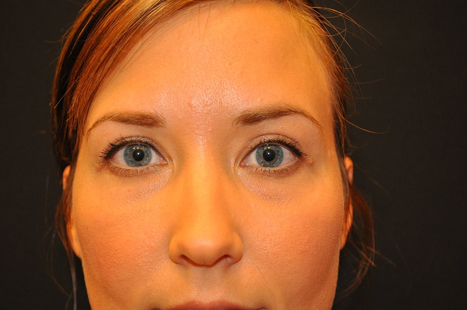 Blephroplasty Before & After