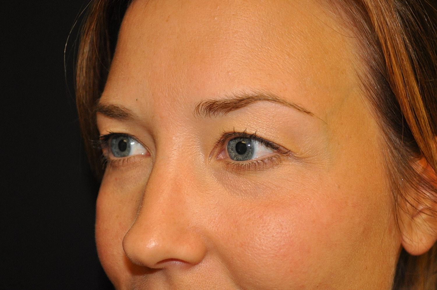 Blephroplasty Before & After