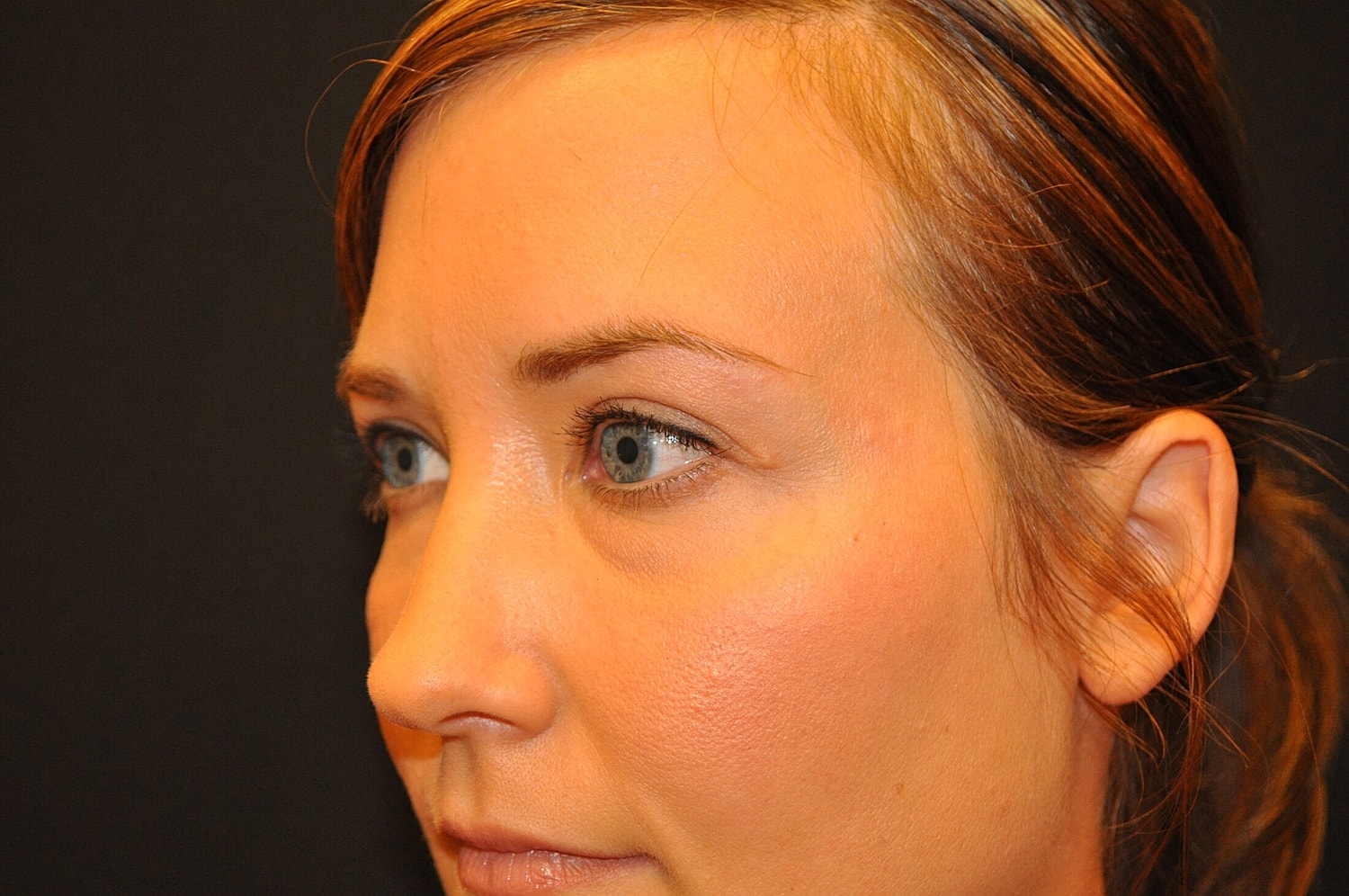 Blephroplasty Before & After