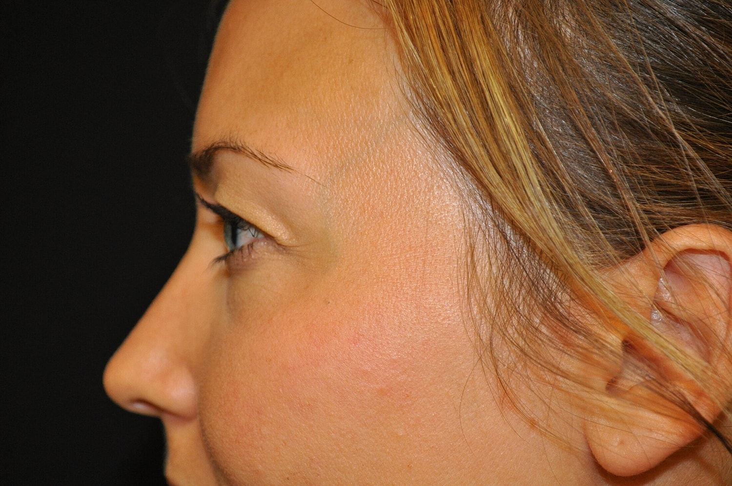 Blephroplasty Before & After