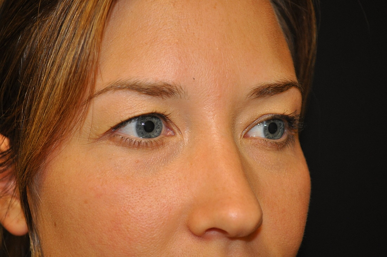 Blephroplasty Before & After