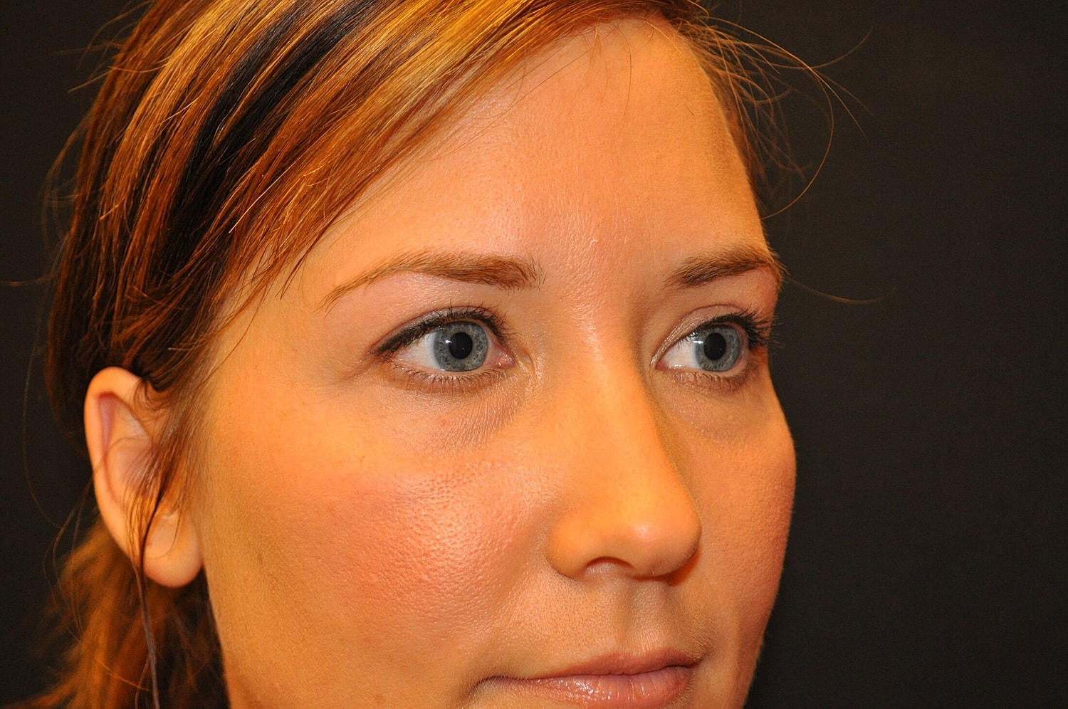 Blephroplasty Before & After