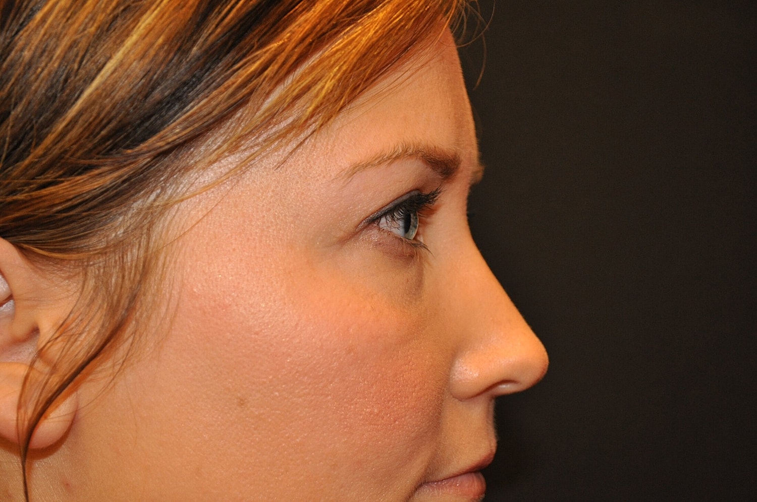 Blephroplasty Before & After