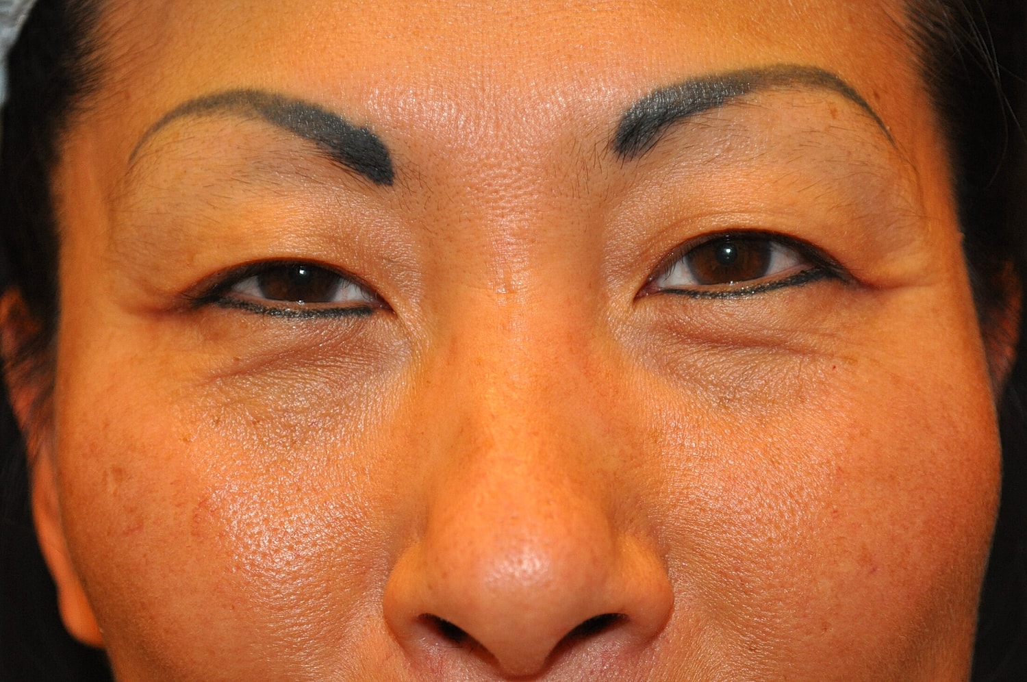 Blephroplasty Before & After