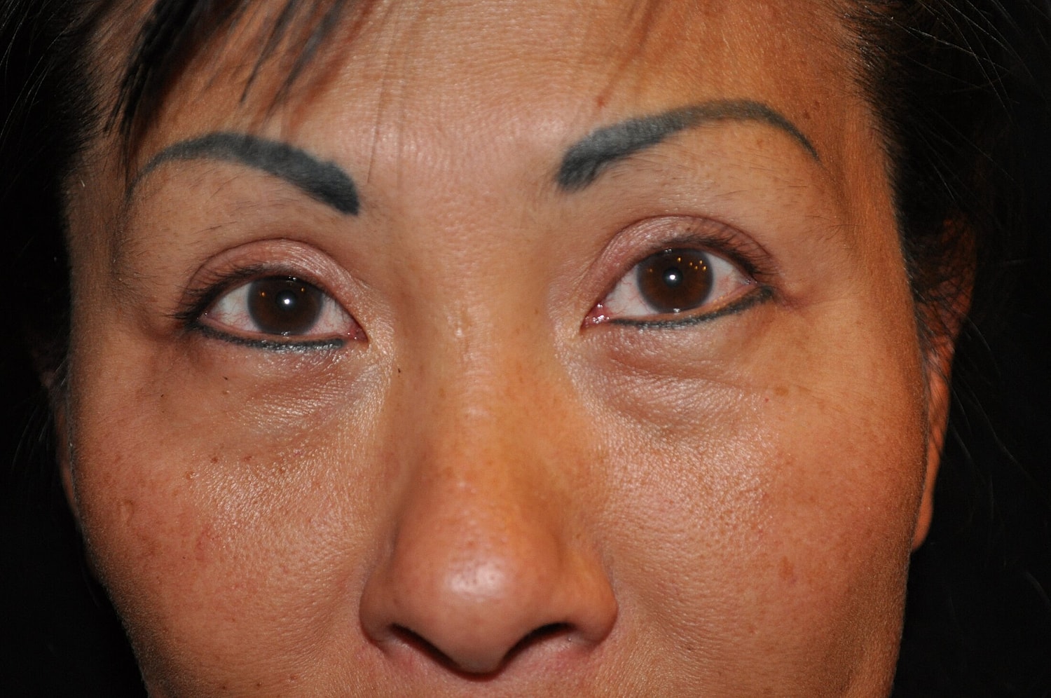 Blephroplasty Before & After