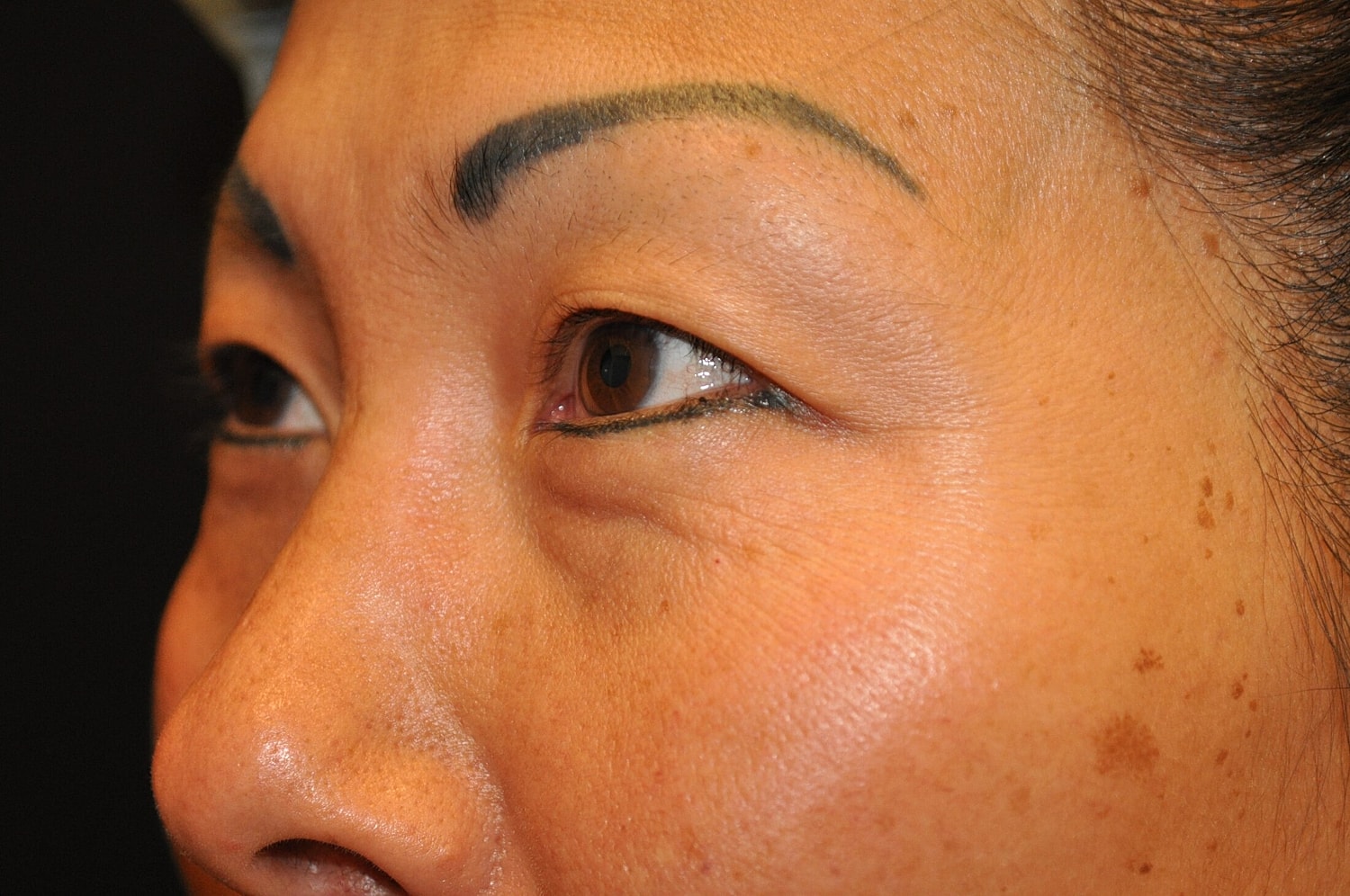 Blephroplasty Before & After