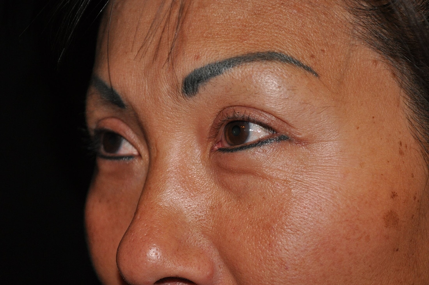 Blephroplasty Before & After