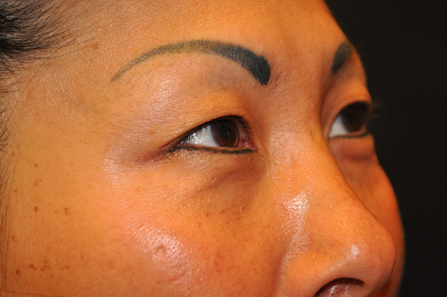 Blephroplasty Before & After