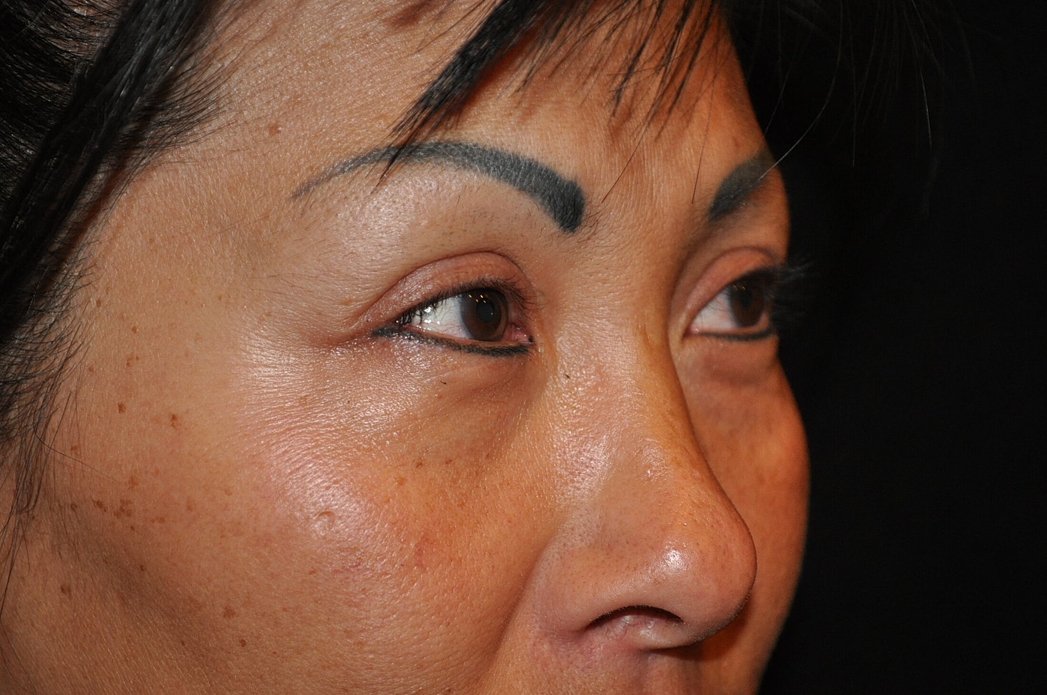 Blephroplasty Before & After