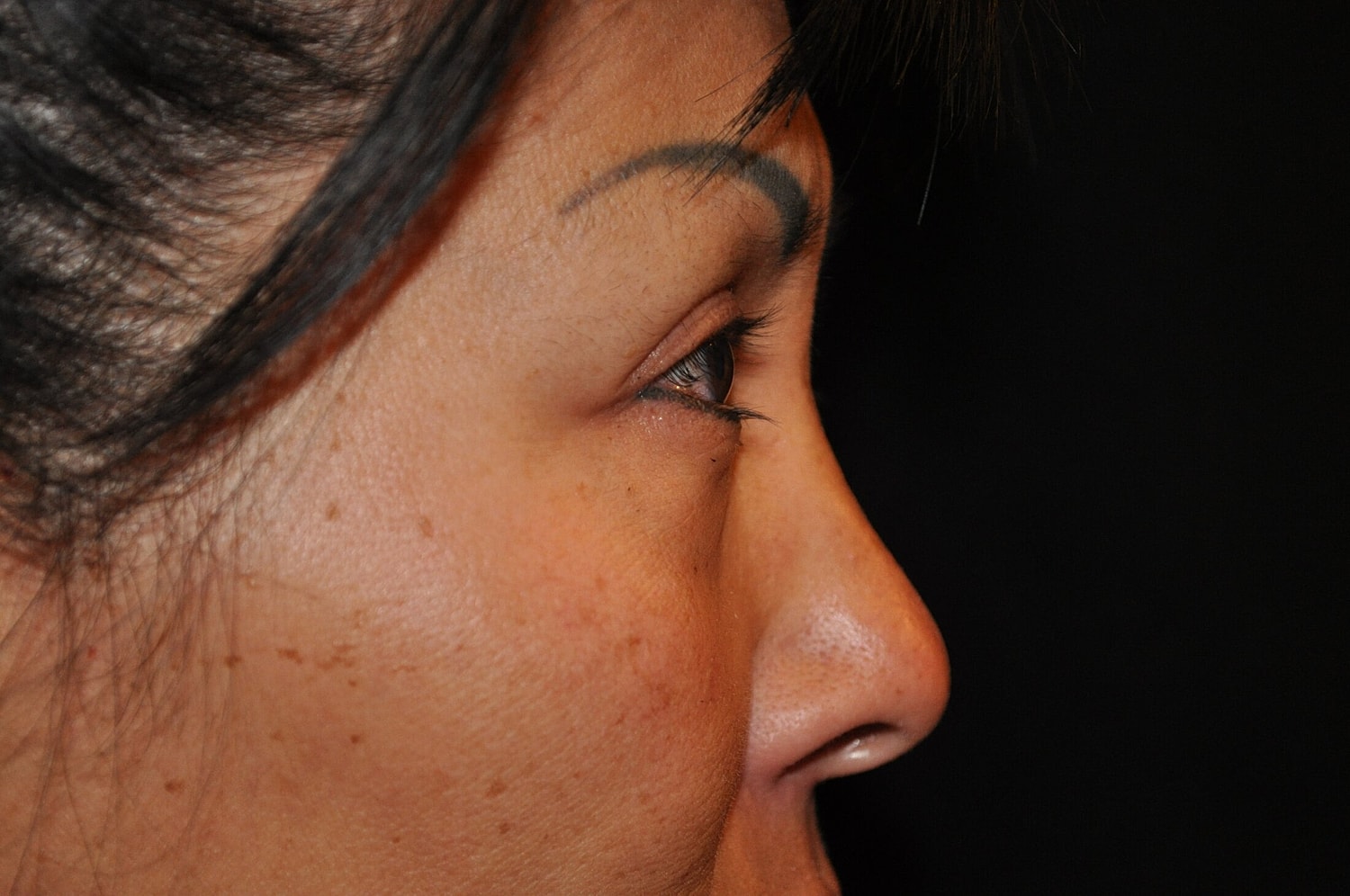 Blephroplasty Before & After