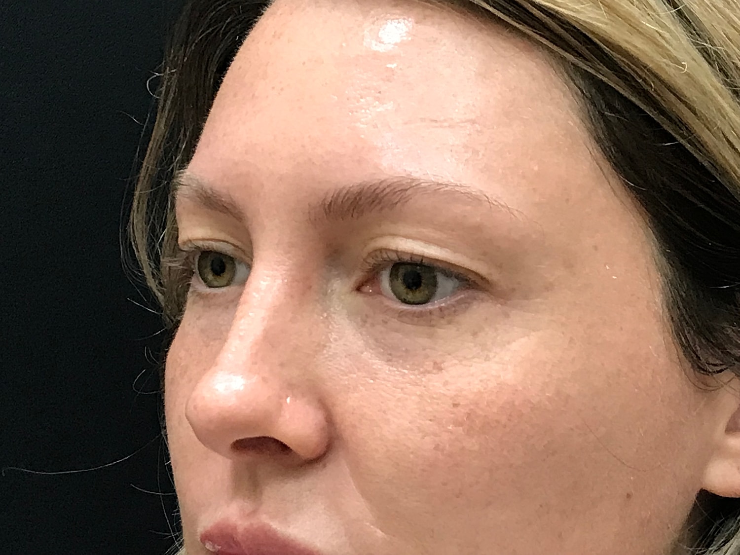 Blephroplasty [.block]Gallery[] Before & After