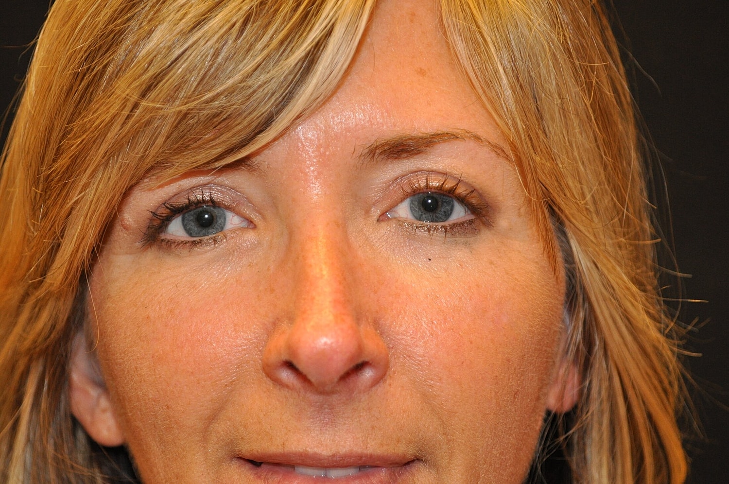 Blephroplasty Before & After