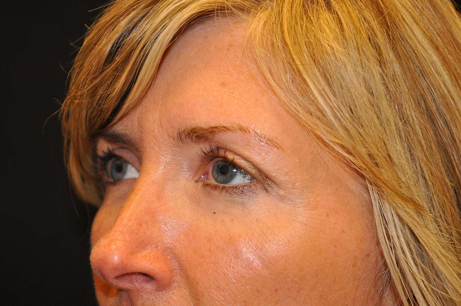 Blephroplasty Before & After