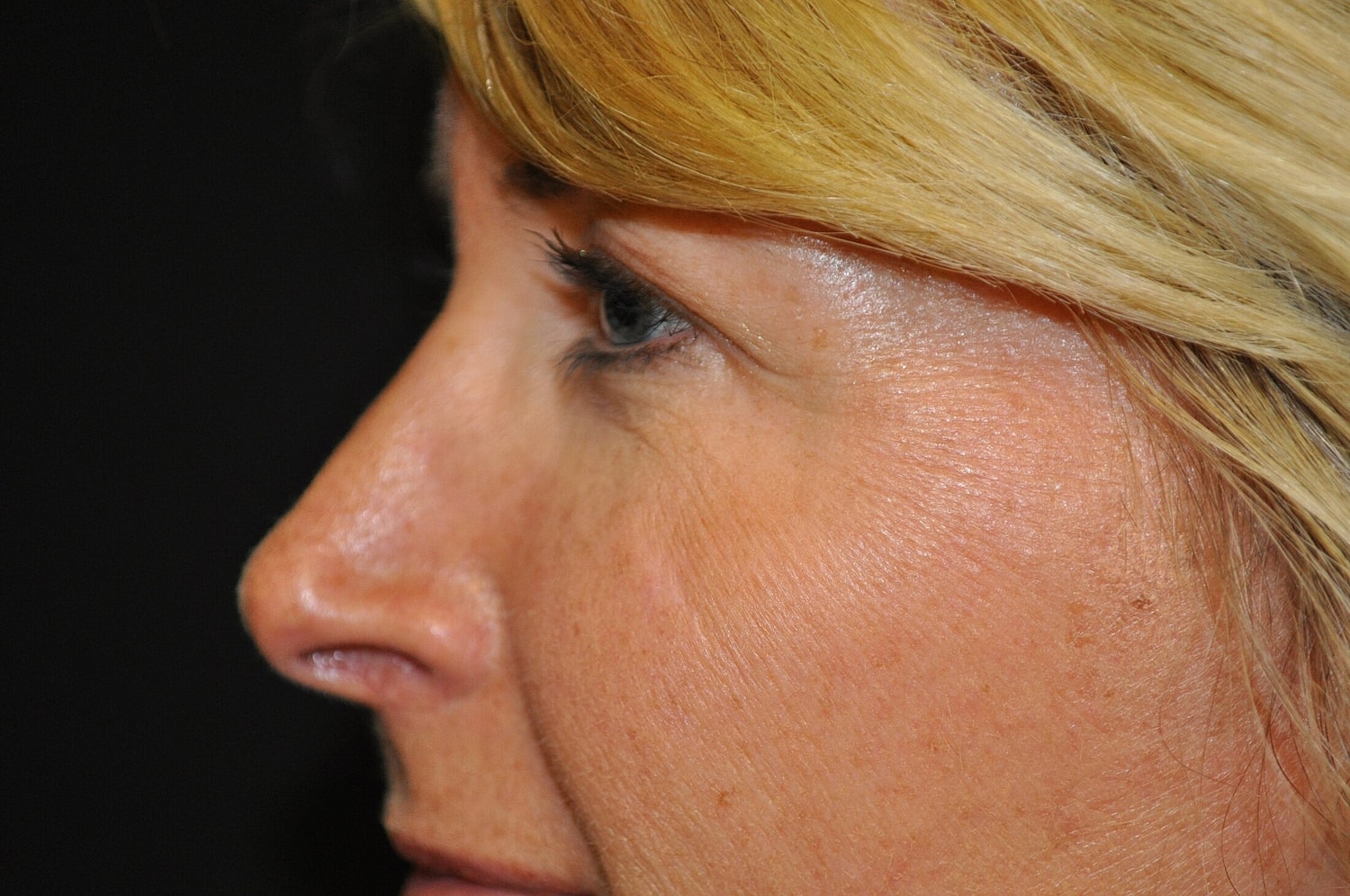 Blephroplasty Before & After